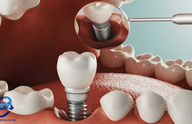 ایمپلنت دندان و دندان پزشکی کره ای