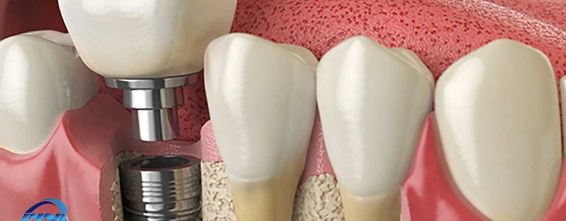 ایمپلنت دندان-ایمپلنت آلمانی دندان-ایمپلنت دندان سوئیسی