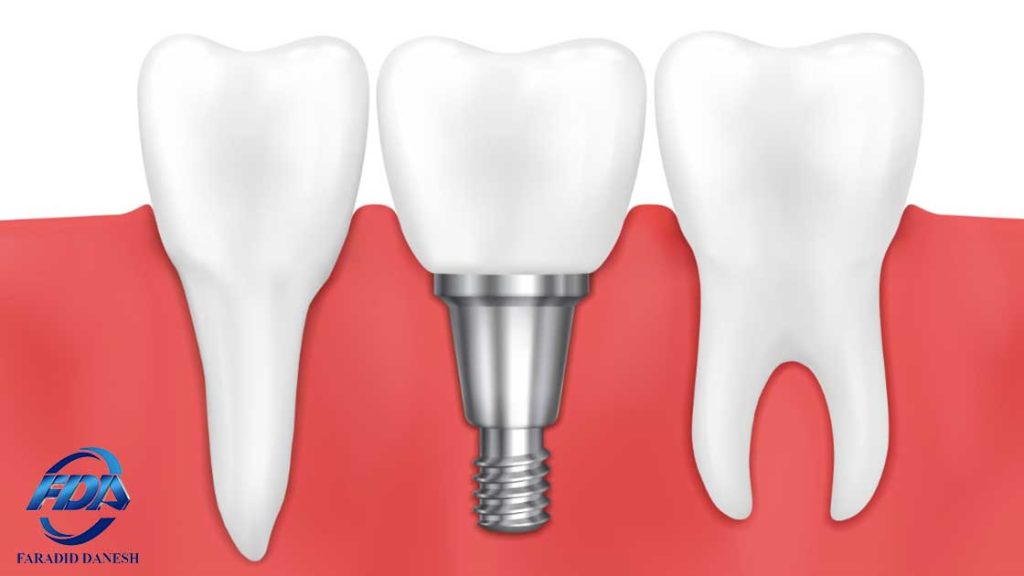 راه های جایگزین ایمپلنت دندان