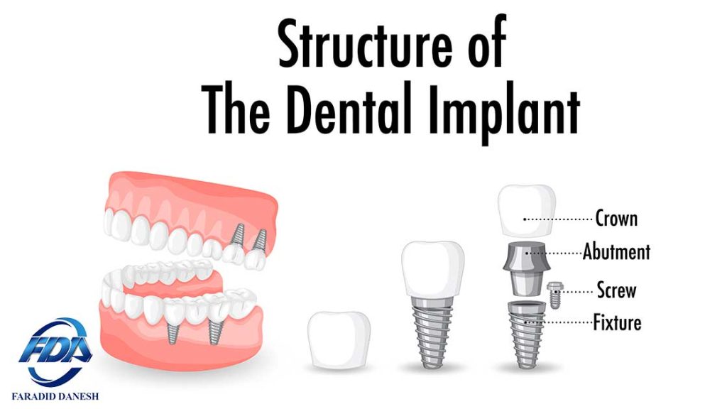 ساختار ایمپلنت های دندانپزشکی