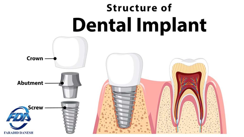 محدودیت سنی در ایمپلنت دندان