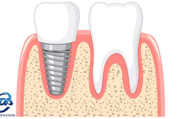 کمترین سن در ایمپلنت های دندان