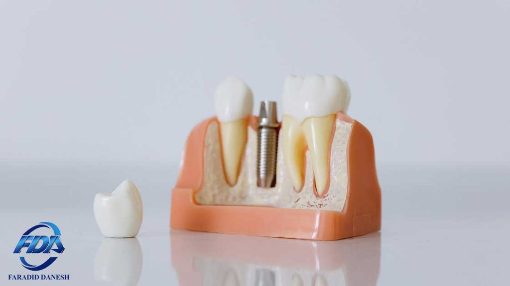 ایمپلنت دندان ساخت کره و سوئیس