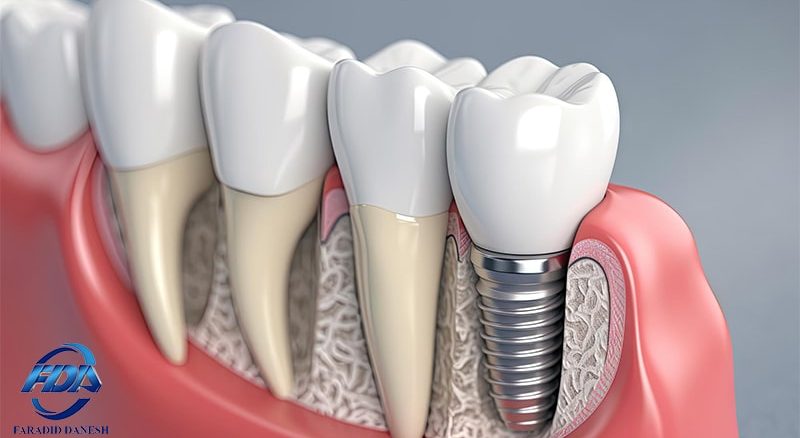 تفاوت دندانپزشک و متخصص ایمپلنت دندان