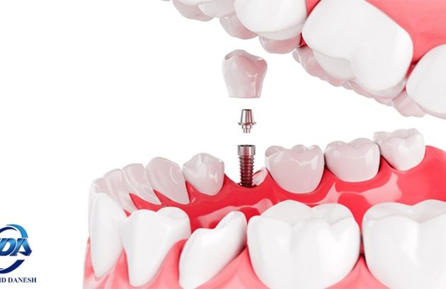 ایمپلنت دندان و بیماران کلیوی