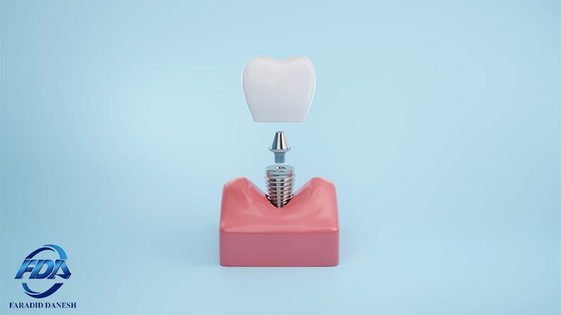 اوردنچر دندان