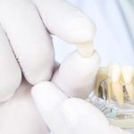 آیا می‌توان پس از جراحی ایمپلنت دندانی، پروتز موقتی قرار داد؟