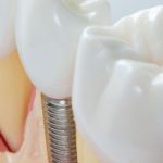 پس از استخراج دندان‌های یک سری، آیا باید با ایمپلنت دندانی دهان کامل خود را درمان کنم؟
