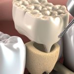 چه اتفاقی می‌افتد اگر پیش از قرار دادن ایمپلنت‌های دندانی‌ام عمل گرافت استخوان انجام ندهم؟