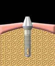 آباتمنت دندان مصنوعی را به ایمپلنت متصل می‌کند.