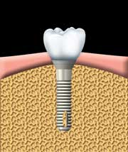 یک دندان مصنوعی به آباتمنت متصل می‌شود.