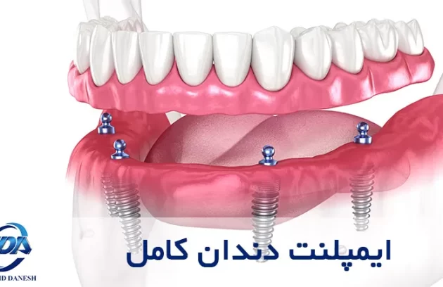 مزایا، معایب و مراحل ایمپلنت کامل دندان چیست