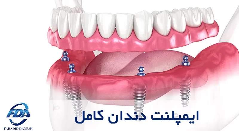 مزایا، معایب و مراحل ایمپلنت کامل دندان چیست
